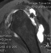 Locked anterior MRI 3